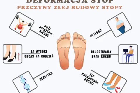 Centralnie umieszczona stopa ludzka, otoczona ikonami ilustrującymi przyczyny deformacji stóp: otyłość, obciążenie siłowe, wysokie obcasy, brak ruchu, genetyka i źle dopasowane obuwie.