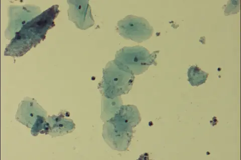 Cellules épithéliales et quelques bactéries, possiblement liées à la gardnerella transmission par l'homme.