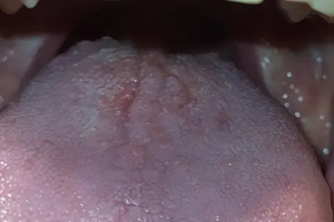 Widoczne grudki na języku z tyłu, przypominające małe kropki, mogą być objawem podrażnienia lub infekcji.