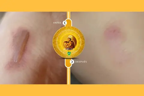 Antes y después de usar la grasa de shea: una cicatriz mejora visiblemente.