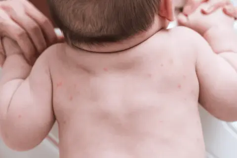 Czerwone kropki na plecach niemowlaka, widoczne potówki.