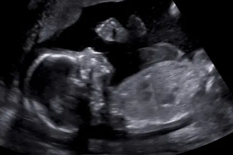 Ultraljudsbild visar två foster. Tidiga symptom på gravid med tvillingar kan vara mer uttalade.