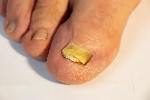 Primo piano di un alluce con unghia gialla e spessa, segno di un'infezione fungina.