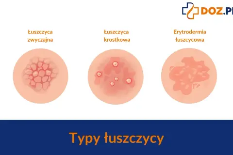 Ilustracja pokazuje trzy typy łuszczycy: zwyczajną, krostkową i erytrodermię łuszczycową. Ważne, by rozpoznać łuszczycę u dzieci.