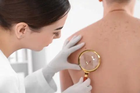 Dermatolog bada plecy pacjenta, skupiając się na jednym, twardym guzkem pod skórą, używając lupy.