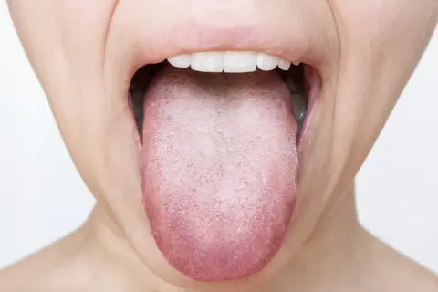 Lingua arrossata e con papille evidenti, possibile segno di candidosi orale.