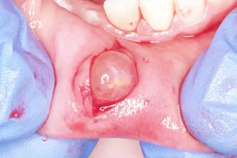 Gloved hands retracting tissue to reveal a translucent, rounded lesion on the gum, likely a fibroma orale.