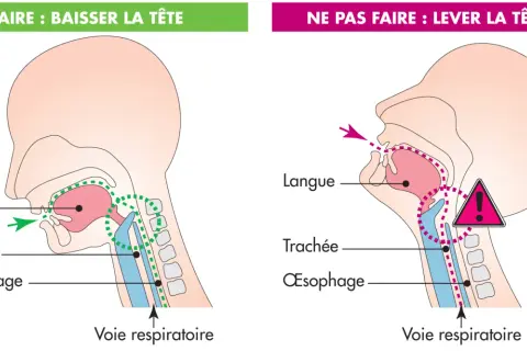 Illustration montrant comment éviter une fausse route chez une personne âgée : baisser la tête pour que la nourriture aille dans l'œsophage et non la trachée.