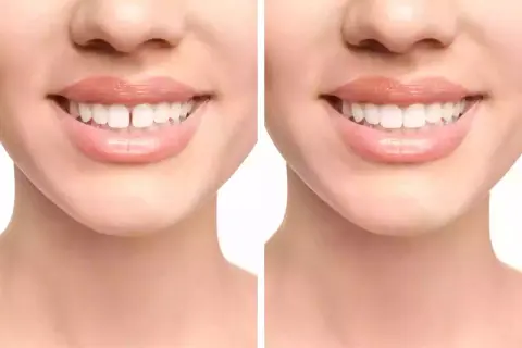 Prima e dopo: il diastema, uno spazio tra i denti, viene corretto per un sorriso perfetto.