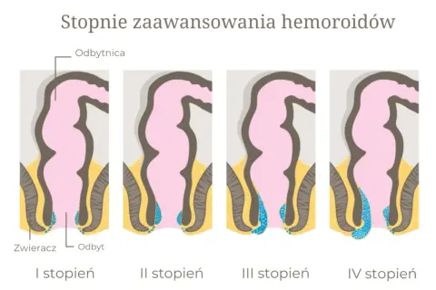 Ilustracja przedstawia stopnie zaawansowania hemoroidów, od I do IV. Różne stopnie mogą mieć różne przyczyny.