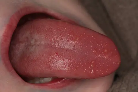Lengua rosada con múltiples ampollas pequeñas y blancas, algunas rojas, visibles en la superficie.