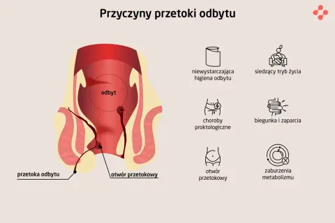 Ilustracja przedstawia anatomię odbytu z widoczną przetoką odbytu. Obok ikony symbolizujące przyczyny: zła higiena, siedzący tryb życia, choroby proktologiczne, biegunka i zaparcia, otwór przetokowy, zaburzenia metabolizmu.