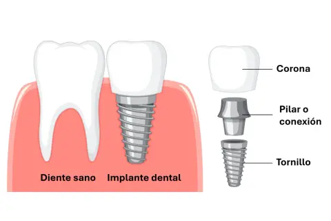 Ilustración de un diente sano y un implante dental con sus componentes: corona, pilar y tornillo dental.