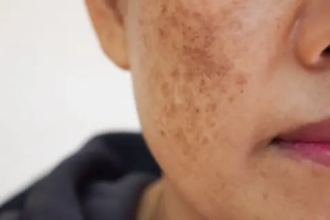 Skóra z przebarwieniami, widoczne plamy melasma na policzku.
