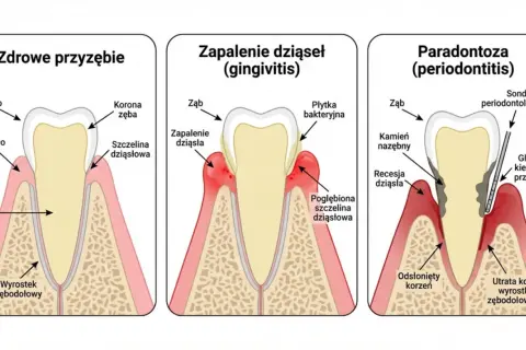 Ilustracja pokazuje postęp paradontozy: zdrowe dziąsła, zapalenie dziąseł i paradontozę. Domowe leczenie paradontozy jest kluczowe.