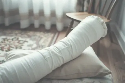 Kiedy gips jest za luźny? Objawy i co zrobić, by uniknąć komplikacji