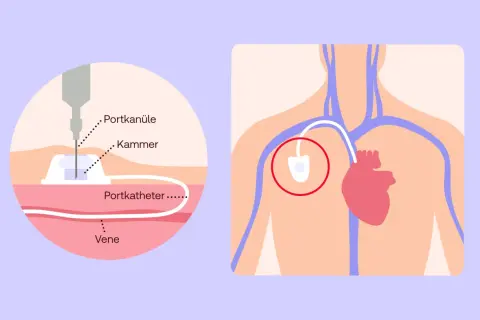 Schema zeigt ein medizinisches Portsystem: eine Nadel (Portkanüle) in der Kammer, verbunden mit einem Katheter in einer Vene. Das Port-System liegt nahe dem Herzen.