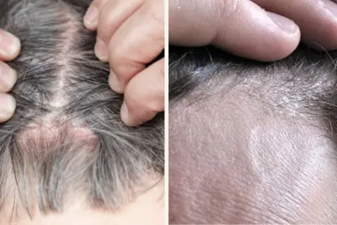 Primer plano de un cuero cabelludo con descamación, mostrando piel irritada y escamas blancas entre el cabello.