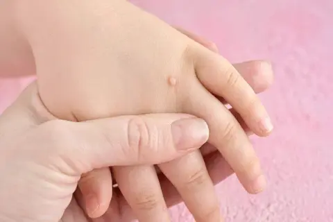 Skąd się biorą kurzajki? Poznaj przyczyny i skutki zakażenia HPV