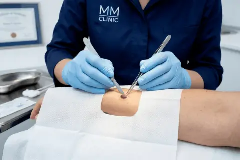 Chirurgiczne usuwanie znamion Kiedy profilaktyka spotyka się z estetyką