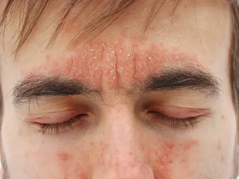Dermatitis zu Hause beruhigen - was wirklich hilft