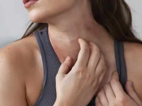 Sarpullido en el cuello - causas, cuidados y cuándo consultar