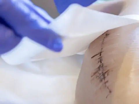 Martwica po lipolizie - jak rozpoznać alarmowe objawy?