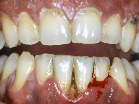 Gengive e denti doloranti - Cause e cosa fare subito