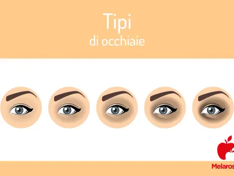Occhiaie Nere - Cause, Tipi e Rimedi Efficaci: La Guida Completa