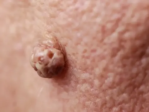Acrochordon douloureux - que faire et quand consulter ?