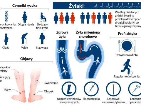 Objawy przewlekłej niewydolności żylnej - Jak przynieść nogom ulgę?