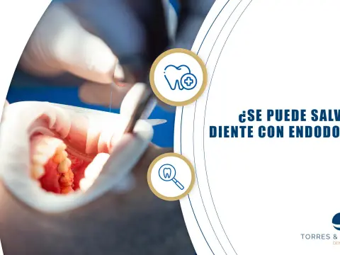 Endodoncia de un diente frontal ¿se puede salvar y se verá natural?