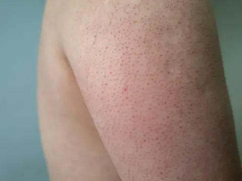Knottror på kinderna? Så känner du igen keratosis pilaris
