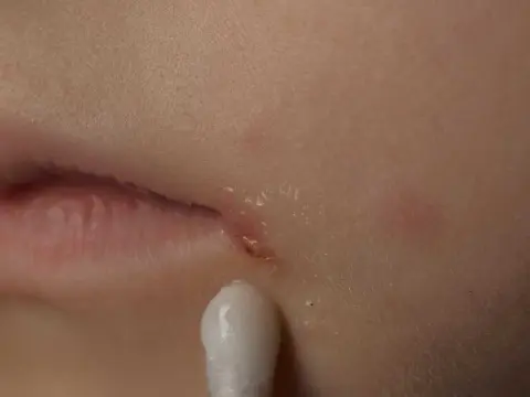 Blåsor i ansiktet - Är det herpes, svinkoppor eller akne?
