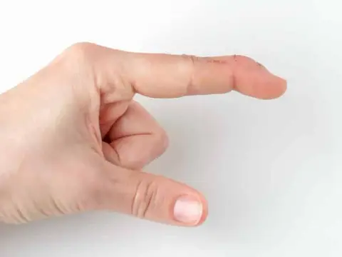 Krzywe palce u rąk na zdjęciach: objawy i typy deformacji
