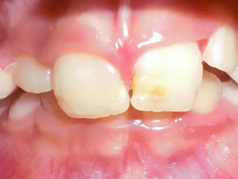 Qué hace el flúor en los dientes y cómo protege el esmalte
