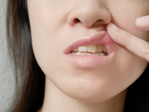 Afta o afte? Come riconoscerle e quando farsi visitare