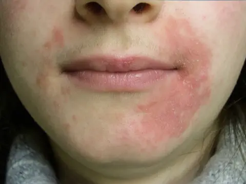 Perioral dermatit runt munnen - Så lugnar du huden effektivt