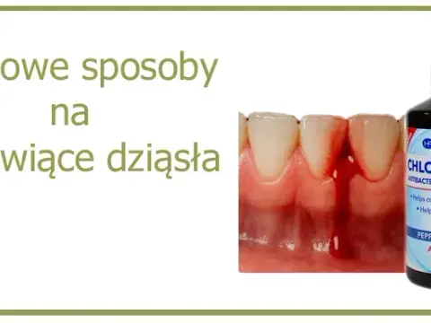 Jaki lek na zapalenie dziąseł? Skuteczne metody i domowe sposoby