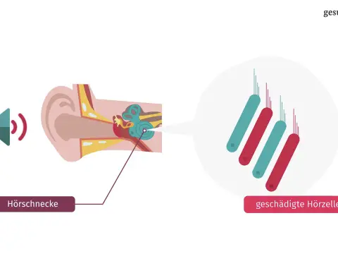 Tinnitus nach Infekt oder Allergie - Wann du handeln musst