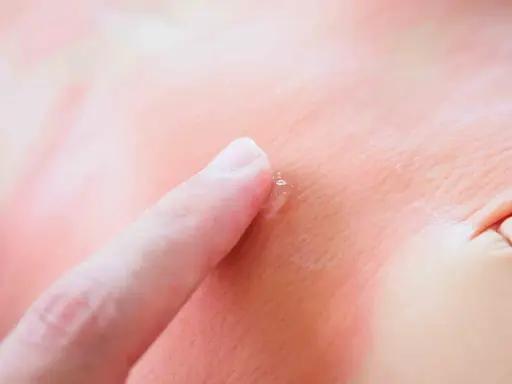 Un doigt touche délicatement un bouton de stress sur une peau rougie, peut-être après une exposition au soleil.