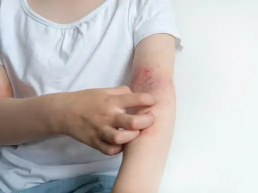 Dziecko drapie swędzącą rękę z zaczerwienioną skórą, objawem co to jest atopowe zapalenie skóry.