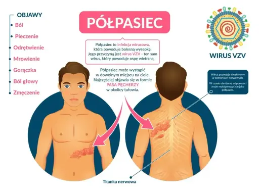 Objawy półpaśca: ból, pieczenie, odrętwienie, mrowienie, gorączka, ból głowy, zmęczenie. Jak złagodzić ból przy półpaścu? Półpasiec to wirus VZV.