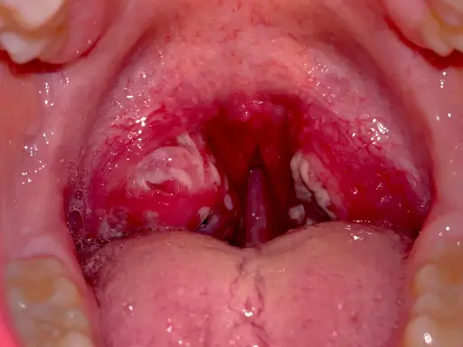 Gola infiammata con placche biancastre, indicative di faringite da streptococco. Le tonsille sono rosse e gonfie.
