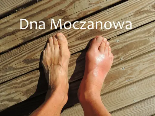 Dwa stopy na drewnianym tle, jeden zdrowy, drugi opuchnięty i zaczerwieniony.