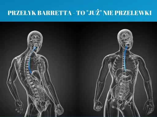 Przełyk Barretta objawy: schematyczne sylwetki ludzkie ukazujące przełyk. Po lewej widok z tyłu, po prawej z przodu.
