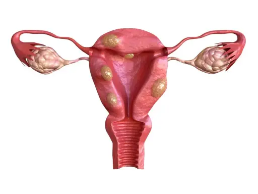 Anatomical illustration of a uterus with multiple fibroids and ovaries.