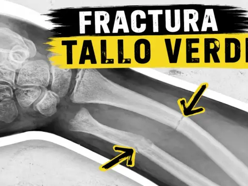 Radiografía de una fractura en tallo verde en el antebrazo, indicada por flechas amarillas.