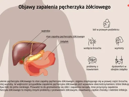 Ilustracja przedstawia anatomię jamy brzusznej z zaznaczonym pęcherzykiem żółciowym, wątrobą i żołądkiem. Wymienia objawy zapalenia pęcherzyka żółciowego: ból, wzdęcia, wymioty, problemy z trawieniem.