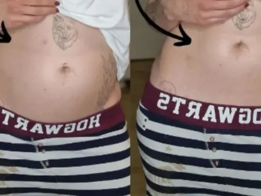 Porównanie brzucha: po lewej widoczne wzdęcia, po prawej płaski. Endometrioza jak wygląda? Czasem tak.